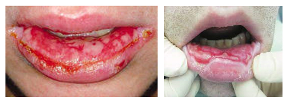 Фото синдрома Стивенса-Джонсона в полости рта
