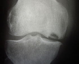 Болезнь Кенига на рентгеновском снимке