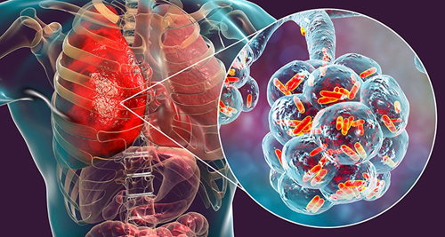 Схематичное изображение нетуберкулезных микобактерий в легких