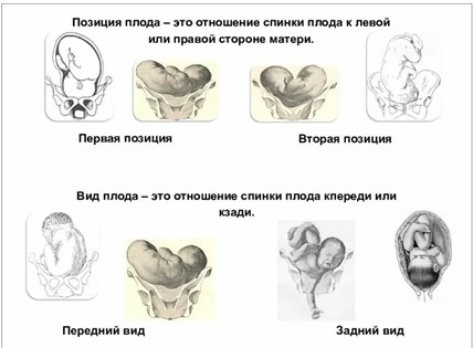 Позиция и вид плода