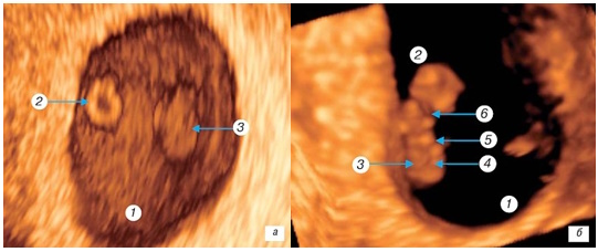 а — беременность 5 недель, б — беременность 6 недель. 1 — амниотическая полость; 2 — желточный мешок (срез); 3 — эмбрион с вентральной поверхности; 4 — головной конец эмбриона; 5, 6 — почки верхних и нижних конечностей