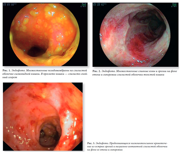 Эндоскопическая картина псевдомембранозного колита