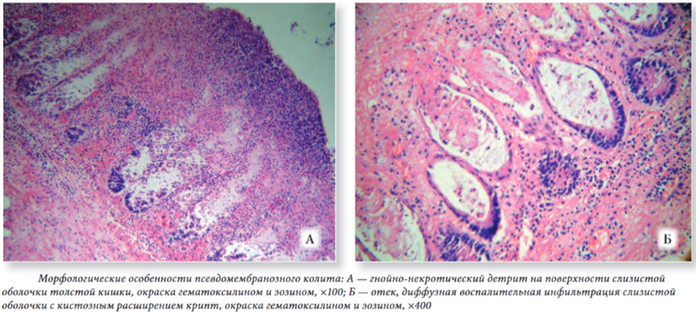 Гистологическая картина псевдомембранозного колита
