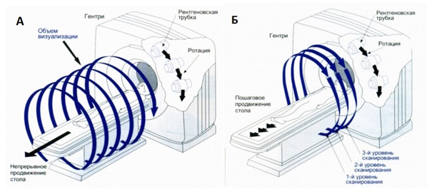 Сравнение спиральной (А) и традиционной (Б) компьютерной томографии