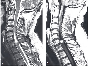 МР-томограмма спинного мозга с контрастированием. Интрамедуллярная астроцитома. а – T2 ВИ; б – T1 ВИ