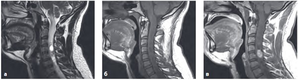 МРТ спинного мозга. Интрамедуллярная гемангиобластома шейного отдела спинного мозга. а – T2 ВИ; б – T1 ВИ до контрастирования; в – T1 ВИ после контрастирования