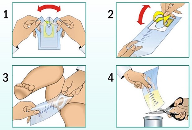 Техника забора мочи у ребенка при помощи одноразового мочеприемника