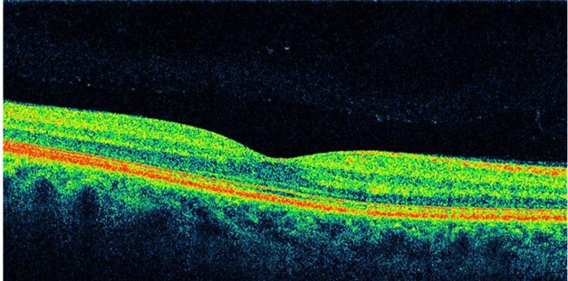 Изображение оптической когерентной томографии сетчатки глаза
