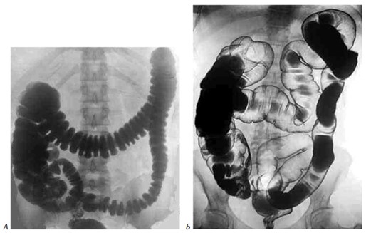 Ирригография: А — обычное исследование; Б — исследование с двойным контрастированием