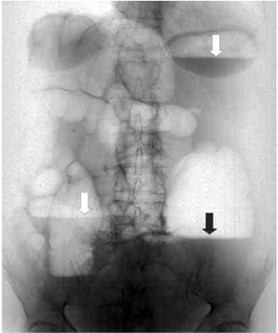 Обзорный снимок брюшной полости. Чаши клойбера на рентгенограмме, характерные для толстокишечной непроходимости