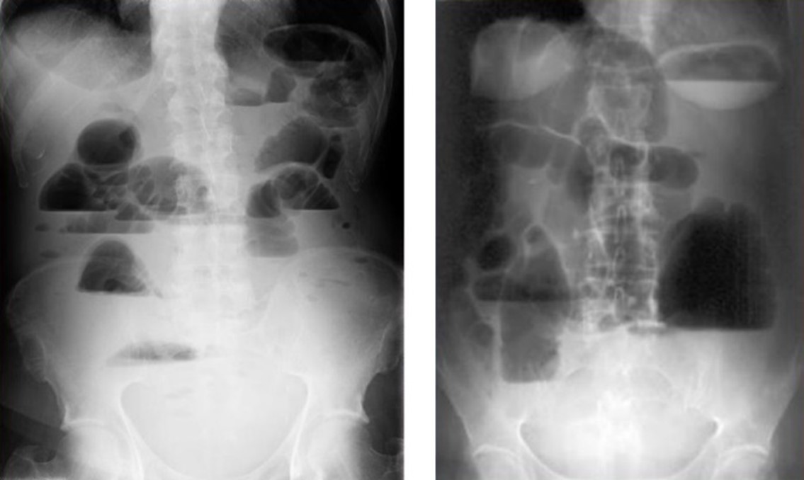 Тонкокишечная (слева) и толстокишечная (справа) непроходимость