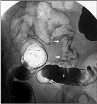 Ирригография. Рак сигмовидной кишки (стрелки), симптом «яблочного огрызка»