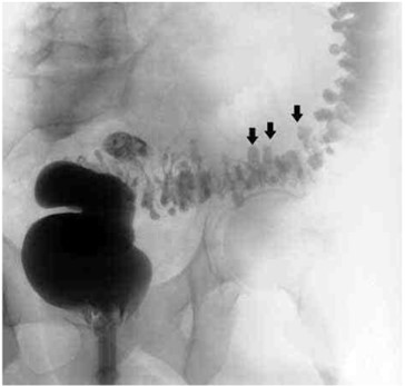 Ирригография. Дивертикулы сигмовидной кишки (стрелки)
