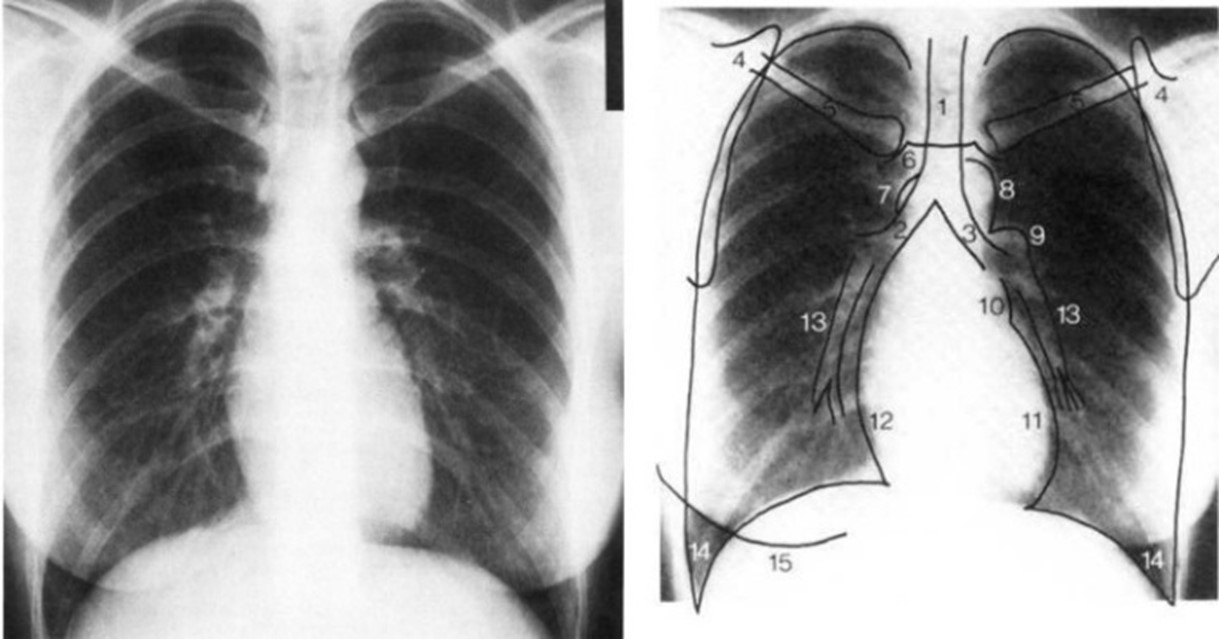 РГ органов грудной клетки в прямой проекции: 1 — трахея; 2 — правый главный бронх; 3 — левый главный бронх; 4 — лопатка; 5 — ключица; 6 — рукоятка грудины; 7 — непарная вена; 8 — дуга аорты; 9 — левая легочная артерия; 10 — верхняя левая дуга сердца, ушко левого предсердия; 11 — нижняя левая дуга сердца, левый желудочек; 12 — правое предсердие; 13 — артерии нижней доли; 14 — латеральный реберно-диафрагмальный синус; 15 — тень молочной железы