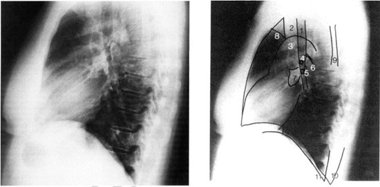 РГ органов грудной клетки в боковой проекции: 1 — трахея; 2 — предтрахеальный сосудистый пучок; 3 — дуга аорты; 4 — правый верхнедолевой бронх; 5 — левый верхнедолевой бронх; 6 — легочная артерия; 7 — правая легочная артерия в предтрахеальном сосудистом пучке; 8 — подмышечная ямка; 9 — лопатка; 10, 11 — задний реберно-диафрагмальный синус