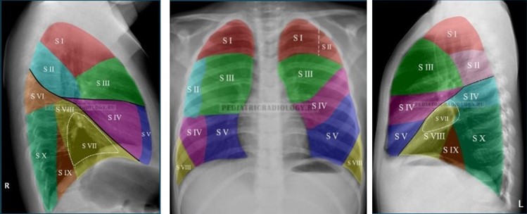 Сегменты легких на рентгенограмме