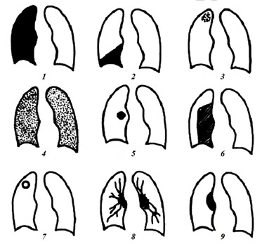 Схемы рентгенологических синдромов поражения дыхательной системы: 1 — обширное затемнение легочного поля; 2 — локальное затемнение; 3 — очаги и ограниченная очаговая диссеминация; 4 — обширная очаговая диссеминация; 5 — круглая тень; 6 — просветление легочного поля; 7 — кольцевидная тень; 8 — изменение легочного рисунка; 9 — патология корней легких