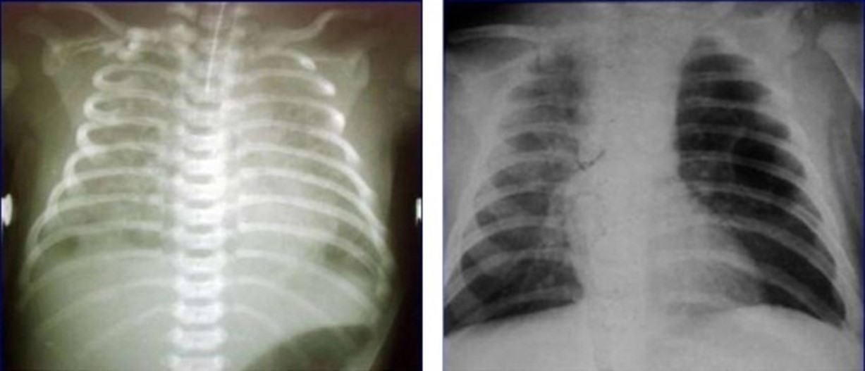 Рентгенограммы легких детей с аспирационным синдромом (мекониальная пневмония)
