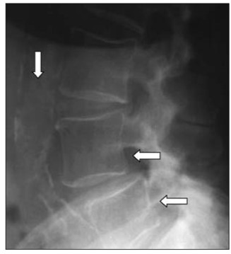 Рентгенограмма поясничного отдела в боковой проекции. Антелистез тел L4– L5. Сужение щели межпозвонкового диска L1– L2. Выраженная кальцификация брюшной аорты. Остеопороз тел позвонков (стрелки)