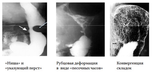 Морфологические признаки язвы