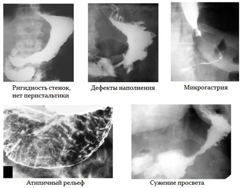 Морфологические признаки рака желудка