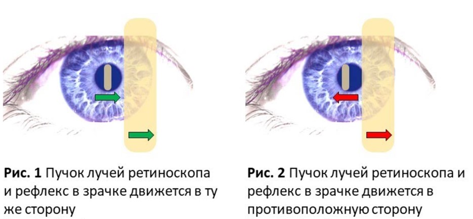 Принцип работы скиаскопа