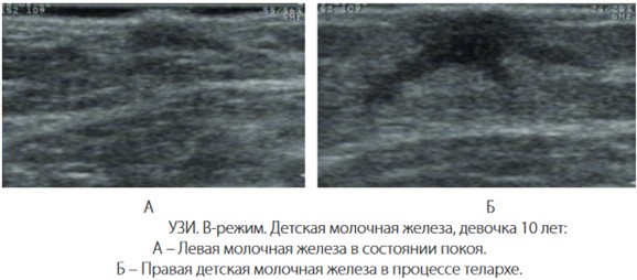 Детская молочная железа