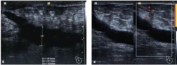 Посттравматическая гематома МЖ, В-режим, ЭК