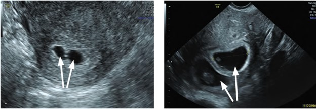 Трансвагинальное сканирование. В полости матки видны два плодных яйца (стрелки)