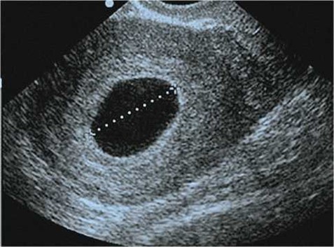 Трансвагинальное ультразвуковое исследование. Беременность 7 недель и 5 дней. Диаметр плодного яйца – 25 мм. Анэмбриония