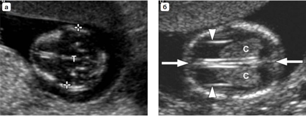 Головка плода (а). Измерение БПР – крестики курсора. Буква Т — третий желудочек, таламус. В этом сечении также измеряется окружность головки. (б) Сосудистые сплетения (С), серп мозга и межполушарная борозда (стрелки) в норме
