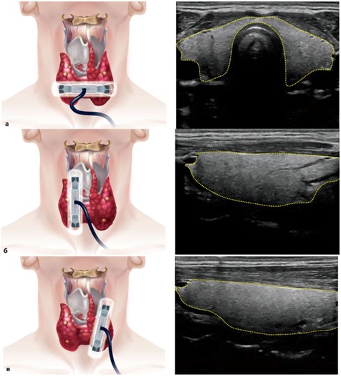 Основные положения ультразвукового датчика при измерениях щитовидной железы: а – поперечный срез; б – продольный срез; в – косой срез