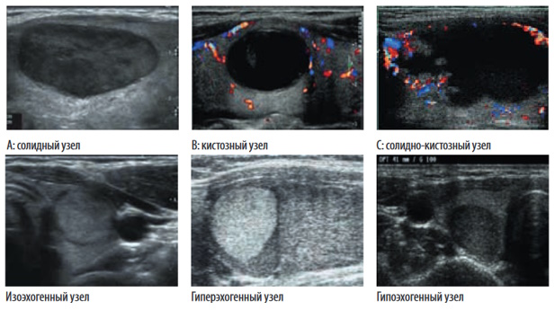 Эхоструктура и эхогенность узловых образований