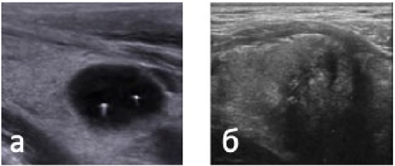 Очаговые изменения ЩЖ: а – макрофолликул со взвесью; б – узел с множественными микрокальцинатами (папиллярный рак)