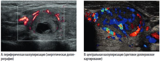 При оценке интранодулярного и перинодулярного кровотока применяется цветовое доплеровское картирование или энергетическая доплерография
