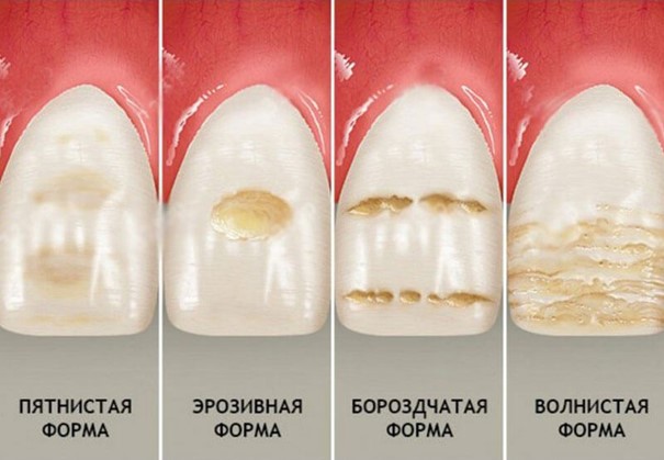 Формы флюороза