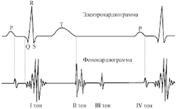 Пример фонокардиограммы