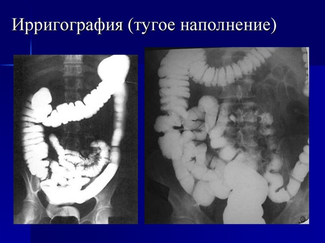 Рентгеновский снимок кишечника