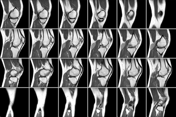 Томограмма коленного сустава