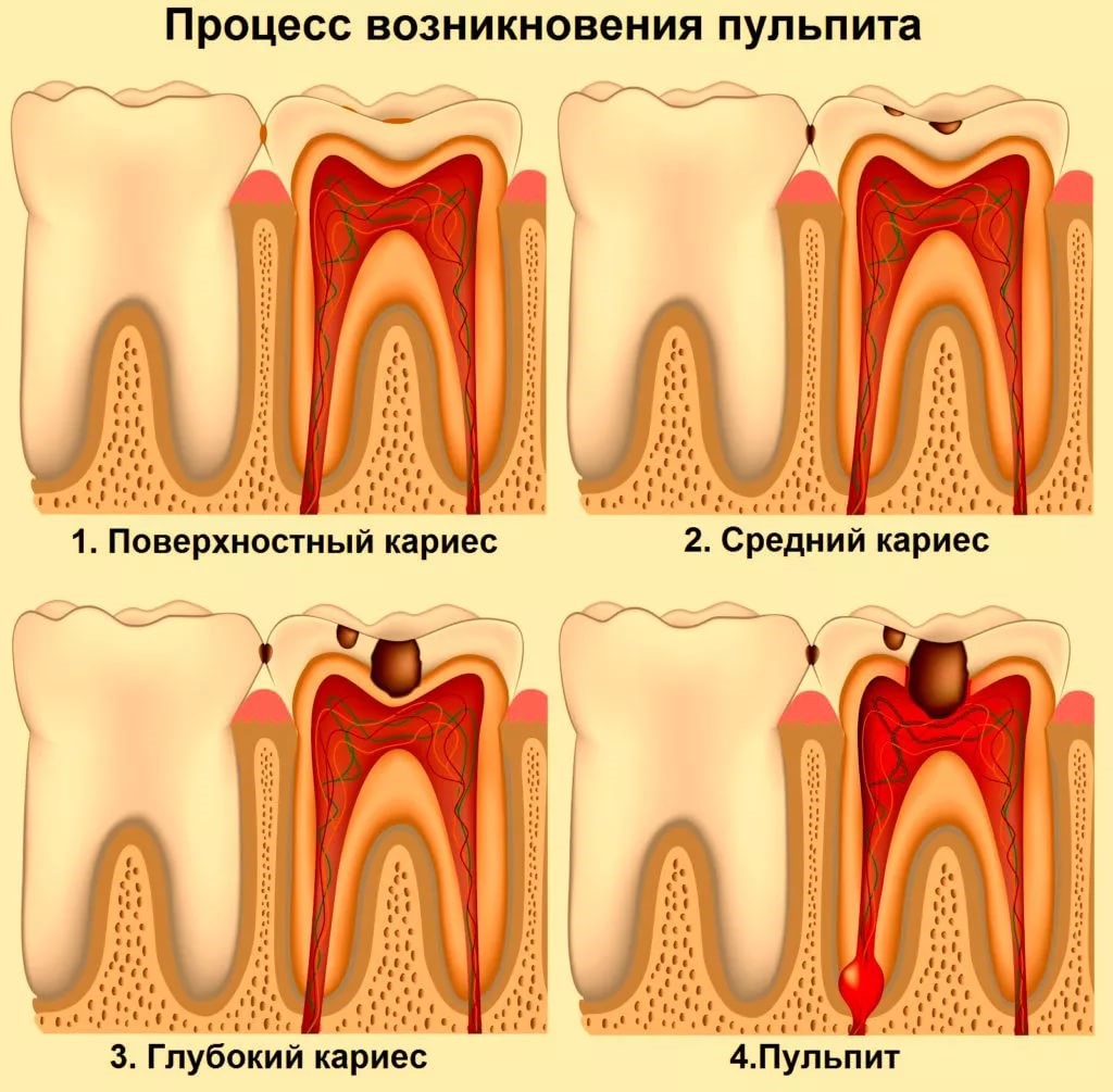 Возникновение пульпита