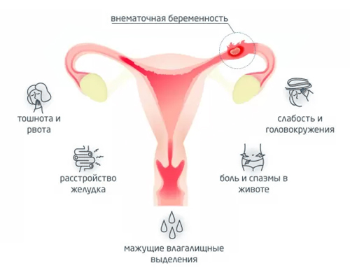 Симптомы внематочной беременности Симптомы внематочной беременности