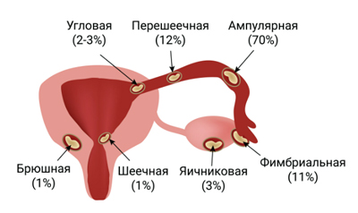 Виды внематочной беременности Виды внематочной беременности