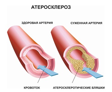 Атеросклероз