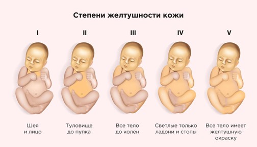 Билирубин у новорожденных