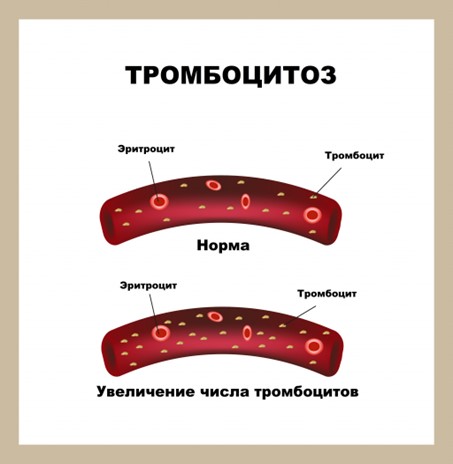 Тромбоцитоз