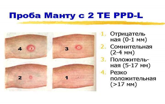 Результаты пробы Манту Результаты пробы Манту