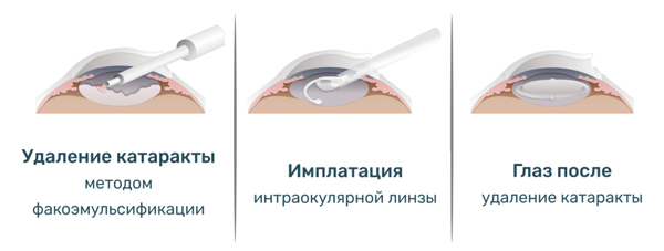 Операция по замене хрусталика