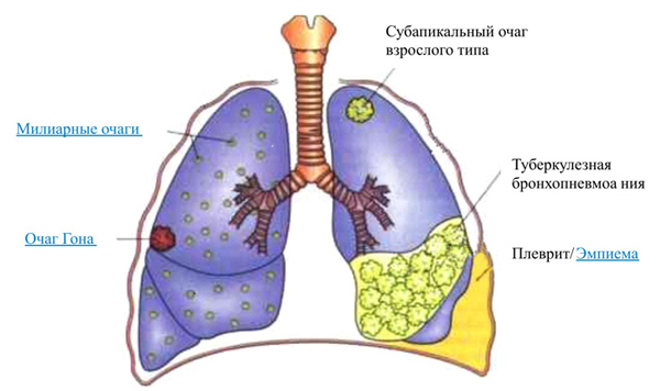 Легочные проявления туберкулеза
