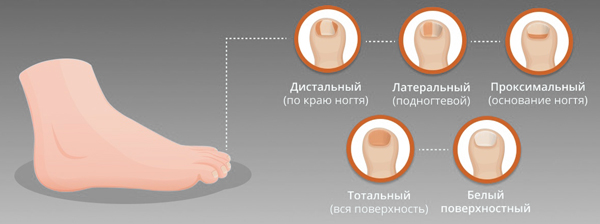 Онихомикоз по месту локализации