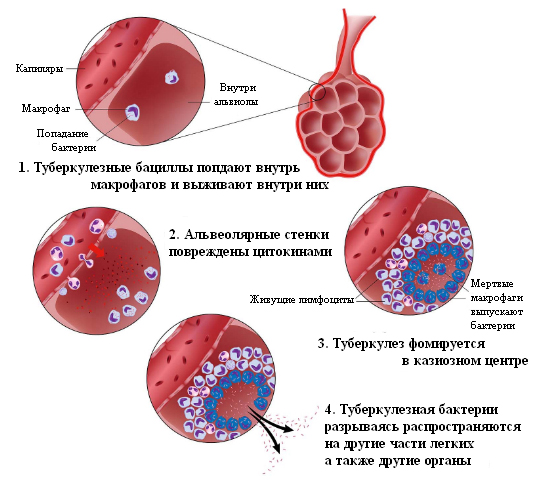 Процесс образования туберкулеза